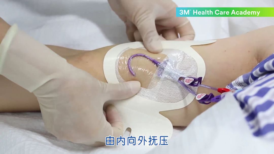 自内而外抚压抹平敷料第三步轻捏导管有效塑形第二步无张力粘贴,切勿