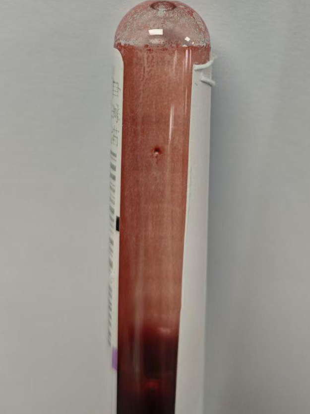 血常规用什么仪器检测秋冬血常规“陷阱”规避：冷凝集与脂血标本处理全攻略来了_https://www.jmylbn.com_新闻资讯_第3张