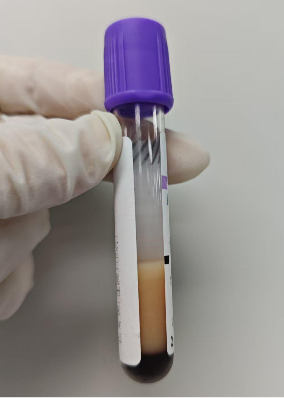 血常规用什么仪器检测秋冬血常规“陷阱”规避：冷凝集与脂血标本处理全攻略来了_https://www.jmylbn.com_新闻资讯_第6张