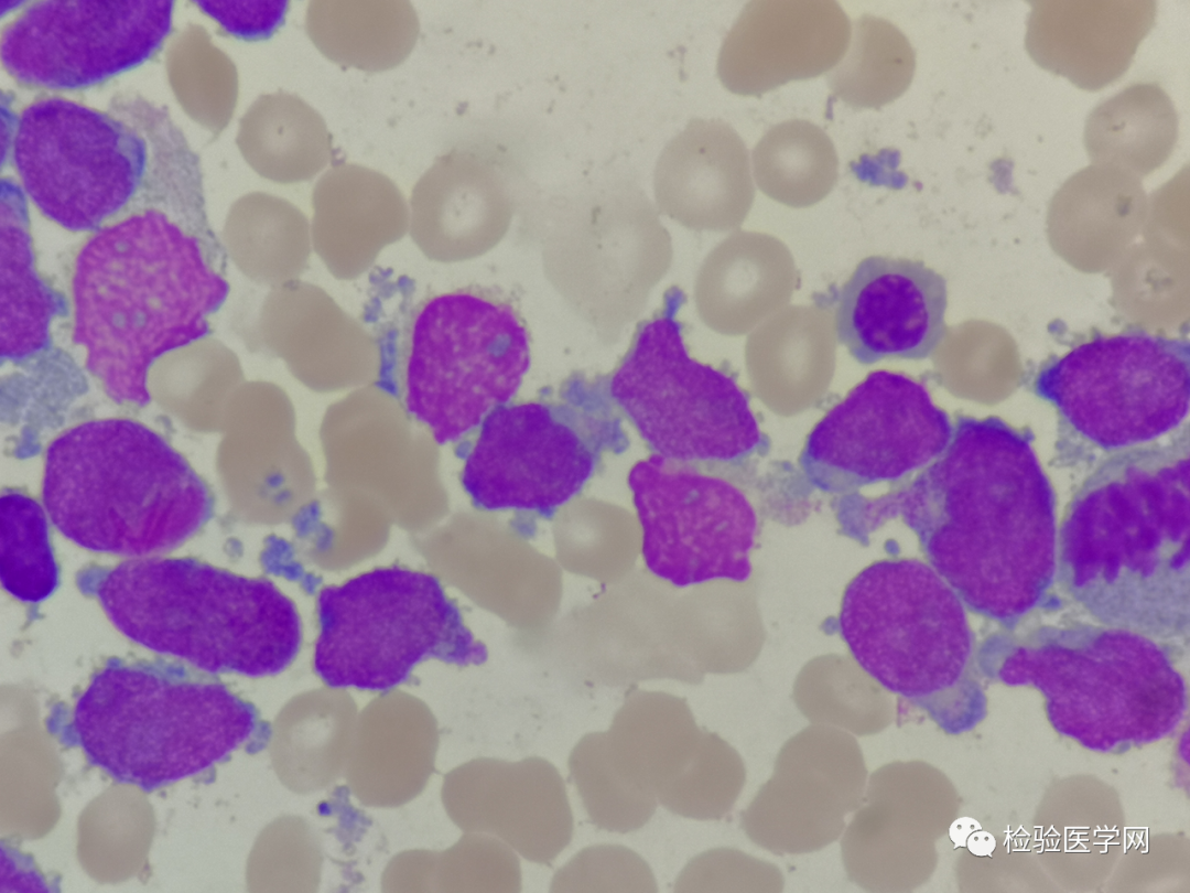 一例罕见凶险的杯口细胞万万没想到结果竟然是