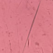 尿沉渣仪器怎么使用“你是谁”？被尿沉渣仪器错过的神秘结晶_https://www.jmylbn.com_新闻资讯_第5张