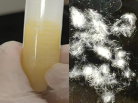 尿沉渣仪器怎么使用“你是谁”？被尿沉渣仪器错过的神秘结晶_https://www.jmylbn.com_新闻资讯_第3张