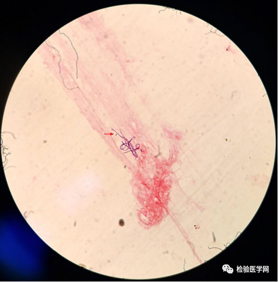 特征不典型抗酸染色弱还能报诺卡菌吗