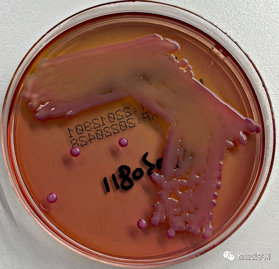 这样「彪悍」的肺炎克雷伯菌感染,你遇到过吗?