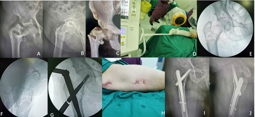 在没有牵引床的情况下，一种简单的牵引方法髓内钉固定粗隆间骨折