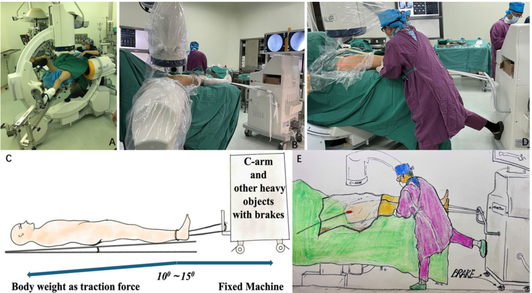在没有牵引床的情况下，一种简单的牵引方法髓内钉固定粗隆间骨折