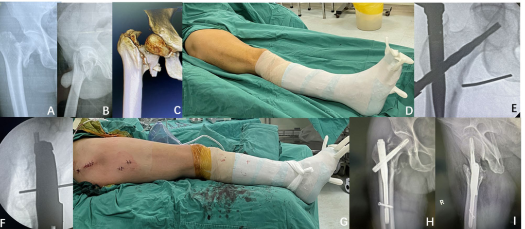 在没有牵引床的情况下，一种简单的牵引方法髓内钉固定粗隆间骨折