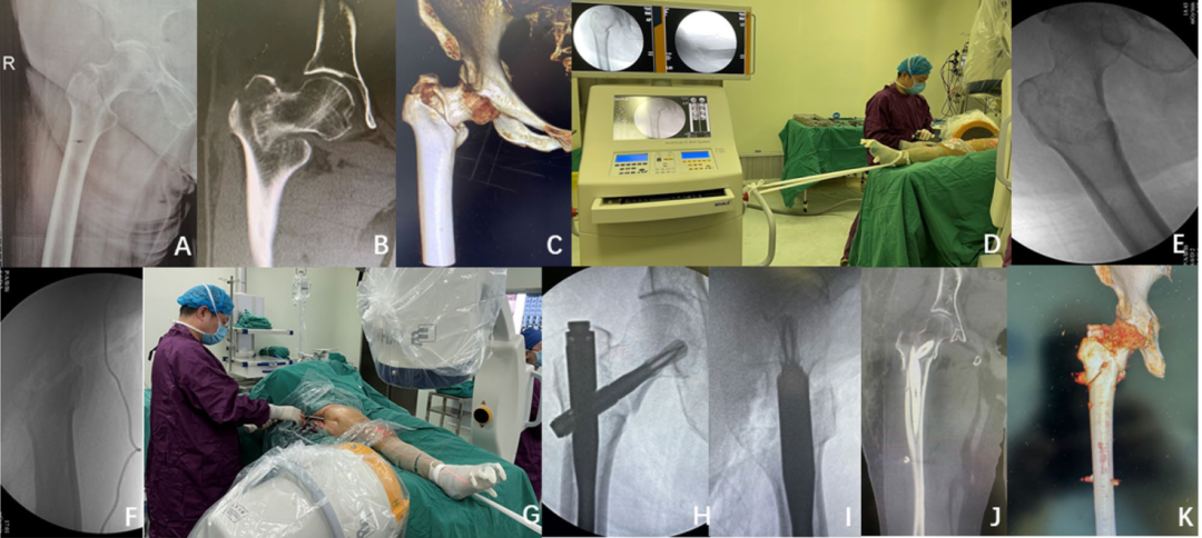 在没有牵引床的情况下，一种简单的牵引方法髓内钉固定粗隆间骨折