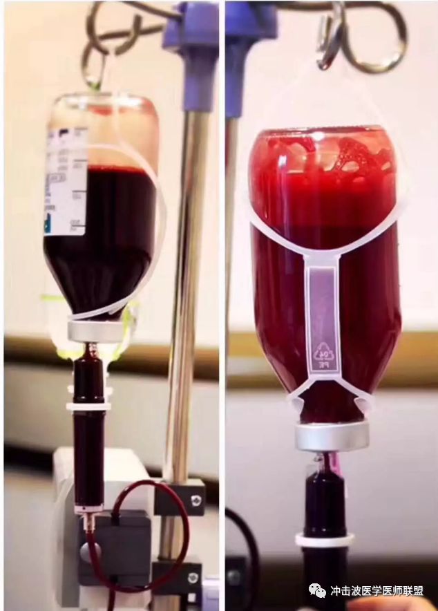 高压臭氧治疗什么HOT高剂量臭氧＂（三氧）＂自血免疫激活疗法_https://www.jmylbn.com_新闻资讯_第1张