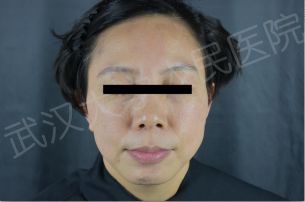 什么是医用透明质酸钠【医学美容】关于透明质酸钠复合溶液（嗨体），你知道吗？_https://www.jmylbn.com_新闻资讯_第18张