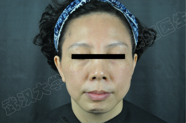 什么是医用透明质酸钠【医学美容】关于透明质酸钠复合溶液（嗨体），你知道吗？_https://www.jmylbn.com_新闻资讯_第17张