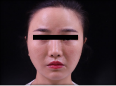 什么是医用透明质酸钠【医学美容】关于透明质酸钠复合溶液（嗨体），你知道吗？_https://www.jmylbn.com_新闻资讯_第23张