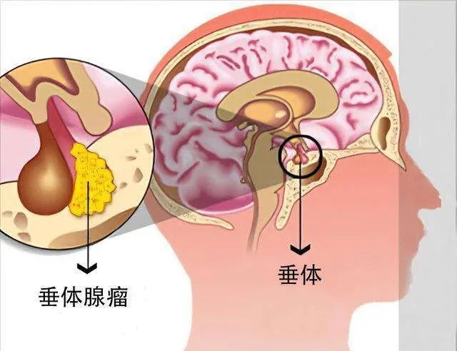 垂体泌乳素腺瘤的治疗_医学界-助力医生临床决策和职业成长