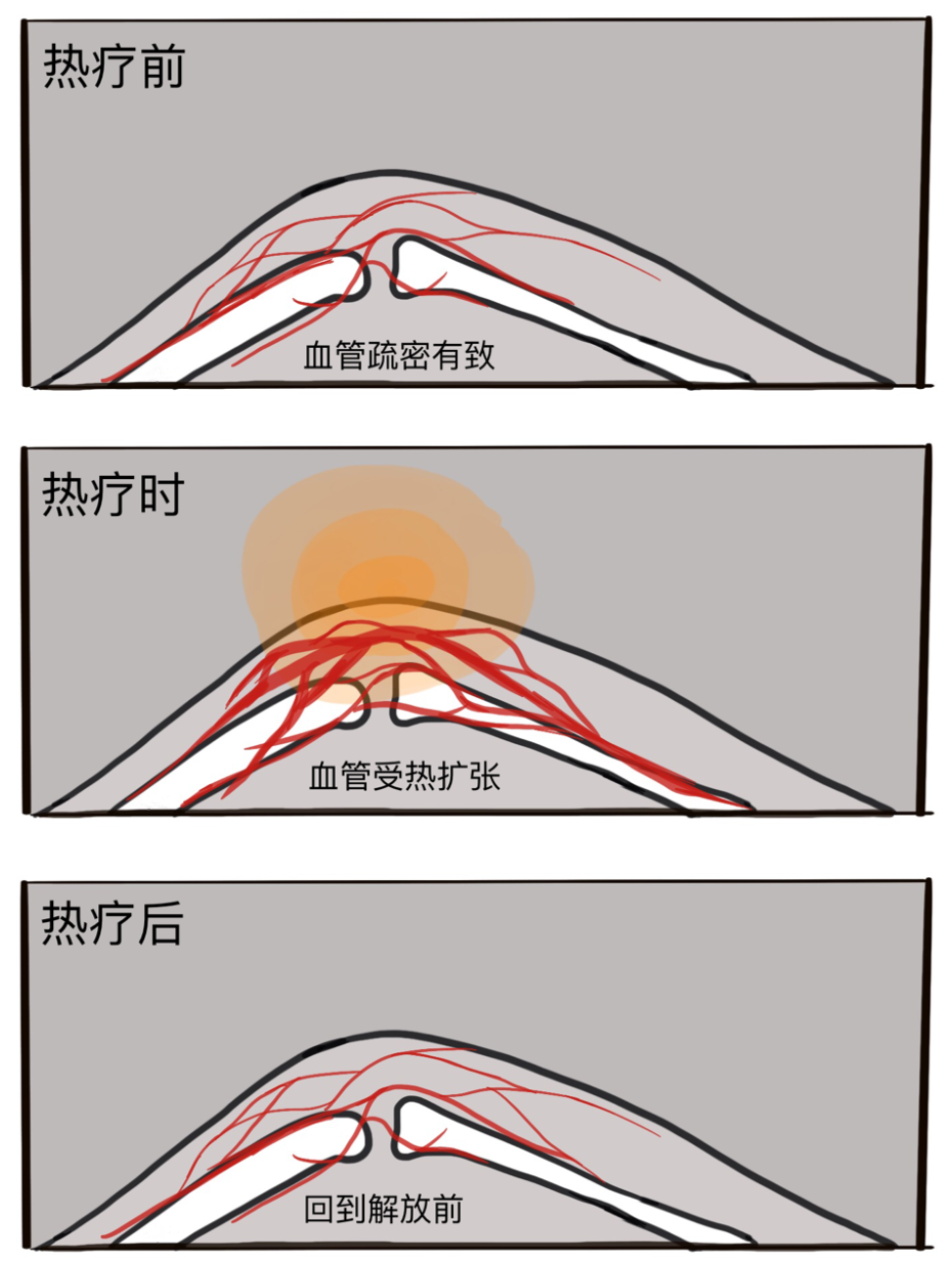 理疗热敷贴怎么贴这个东西是老寒腿克星！每天坚持能让腿脚年轻20岁！_https://www.jmylbn.com_新闻资讯_第22张