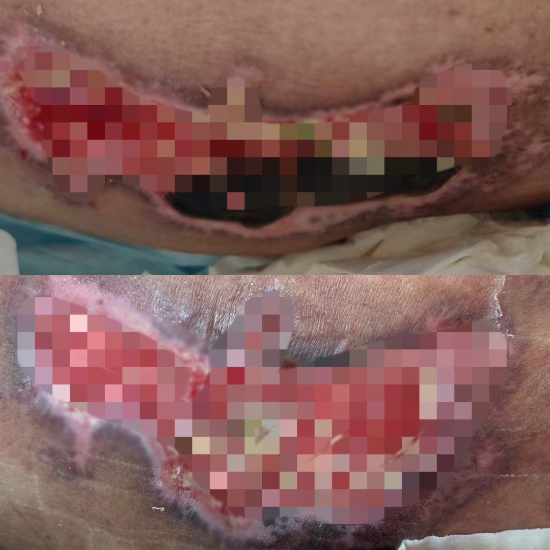 抗菌清创敷料怎么使用这个护士长独创＂三步清创法＂，让压疮愈合快人一步！_https://www.jmylbn.com_新闻资讯_第5张