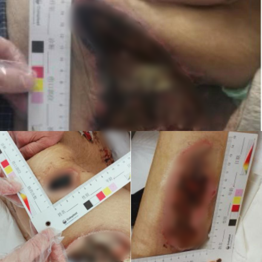 抗菌清创敷料怎么使用这个护士长独创＂三步清创法＂，让压疮愈合快人一步！_https://www.jmylbn.com_新闻资讯_第3张