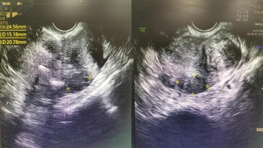 肌瘤钻怎么写肌瘤长满子宫，分布位置刁钻！医生如何拆解体内隐患“炸弹”？_https://www.jmylbn.com_新闻资讯_第2张