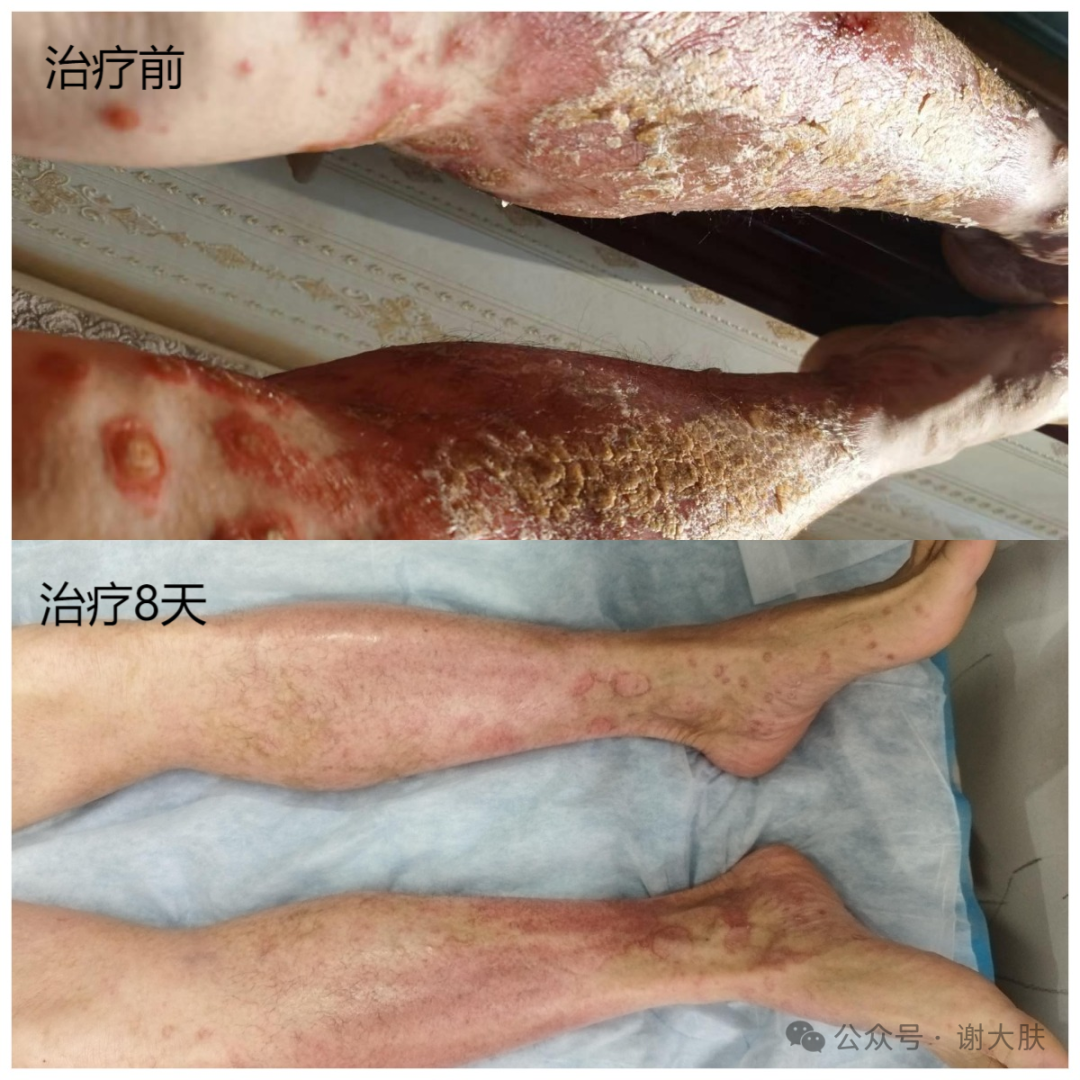 从"不敢脱衣"到"大胆示人",一位国企老总23年的皮肤病求医路