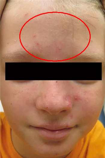 图源@医学界儿科频道老育提示:一般痤疮,蠕形螨毛囊炎,丘疹脓疱性玫瑰