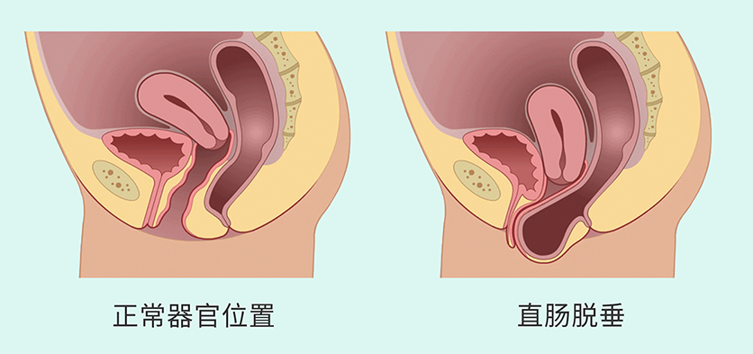 盆腔脏器脱垂3.png
