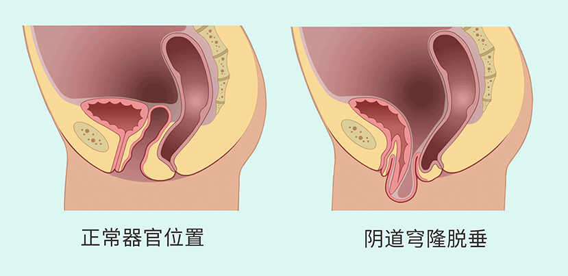 盆腔脏器脱垂5.png