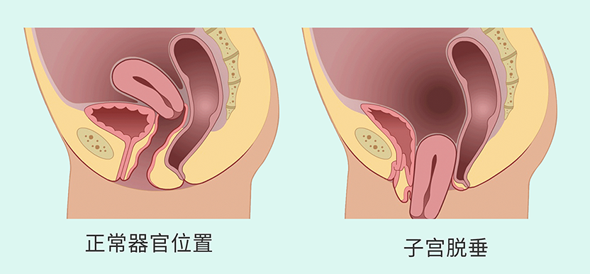 盆腔脏器脱垂4.png