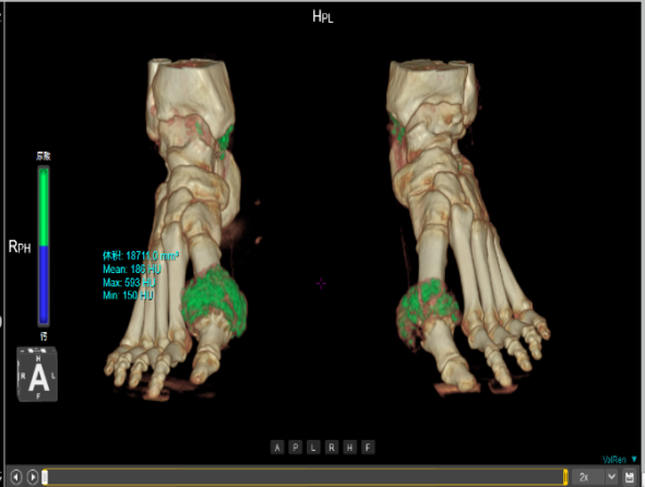 联影ct怎么样【小南快讯】辐射低、成像快、更精确！CT届的“天花板”——320排640层超高端CT落户奉中心！_https://www.jmylbn.com_新闻资讯_第18张