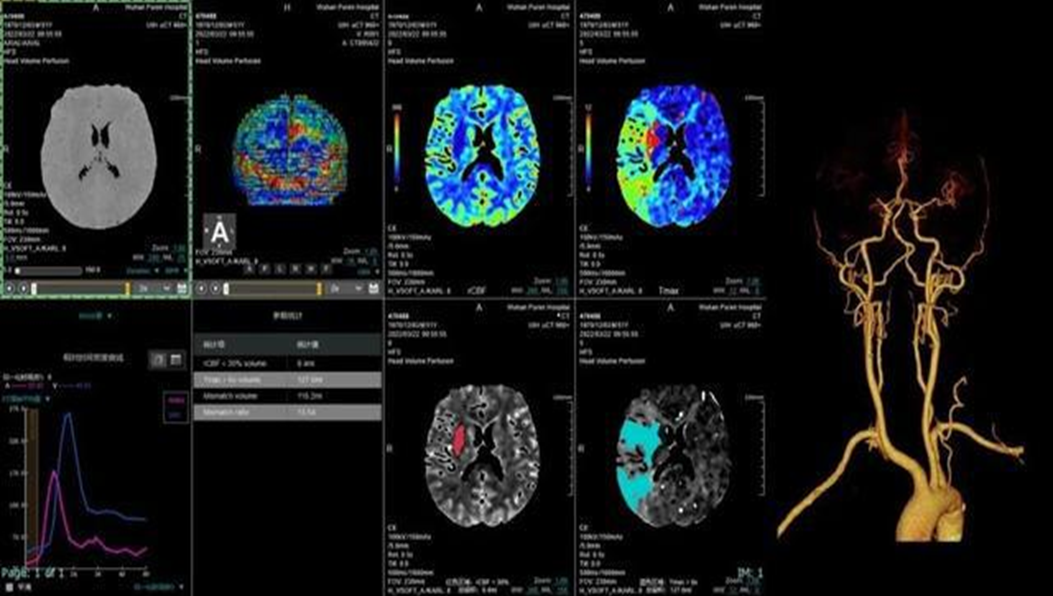 联影ct怎么样【小南快讯】辐射低、成像快、更精确！CT届的“天花板”——320排640层超高端CT落户奉中心！_https://www.jmylbn.com_新闻资讯_第15张