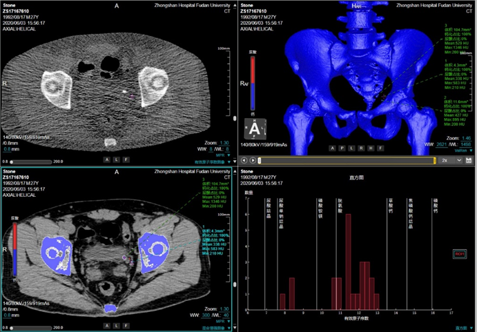 联影ct怎么样【小南快讯】辐射低、成像快、更精确！CT届的“天花板”——320排640层超高端CT落户奉中心！_https://www.jmylbn.com_新闻资讯_第19张