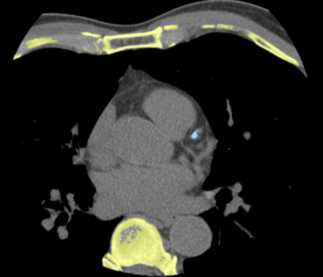 联影ct怎么样【小南快讯】辐射低、成像快、更精确！CT届的“天花板”——320排640层超高端CT落户奉中心！_https://www.jmylbn.com_新闻资讯_第13张