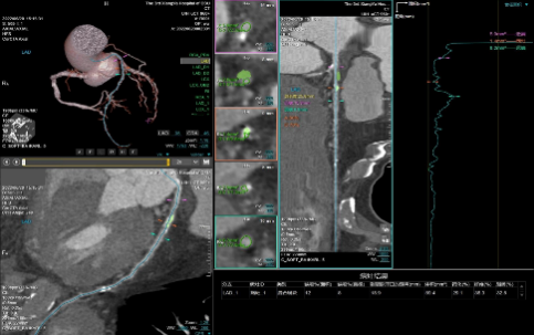 联影ct怎么样【小南快讯】辐射低、成像快、更精确！CT届的“天花板”——320排640层超高端CT落户奉中心！_https://www.jmylbn.com_新闻资讯_第7张