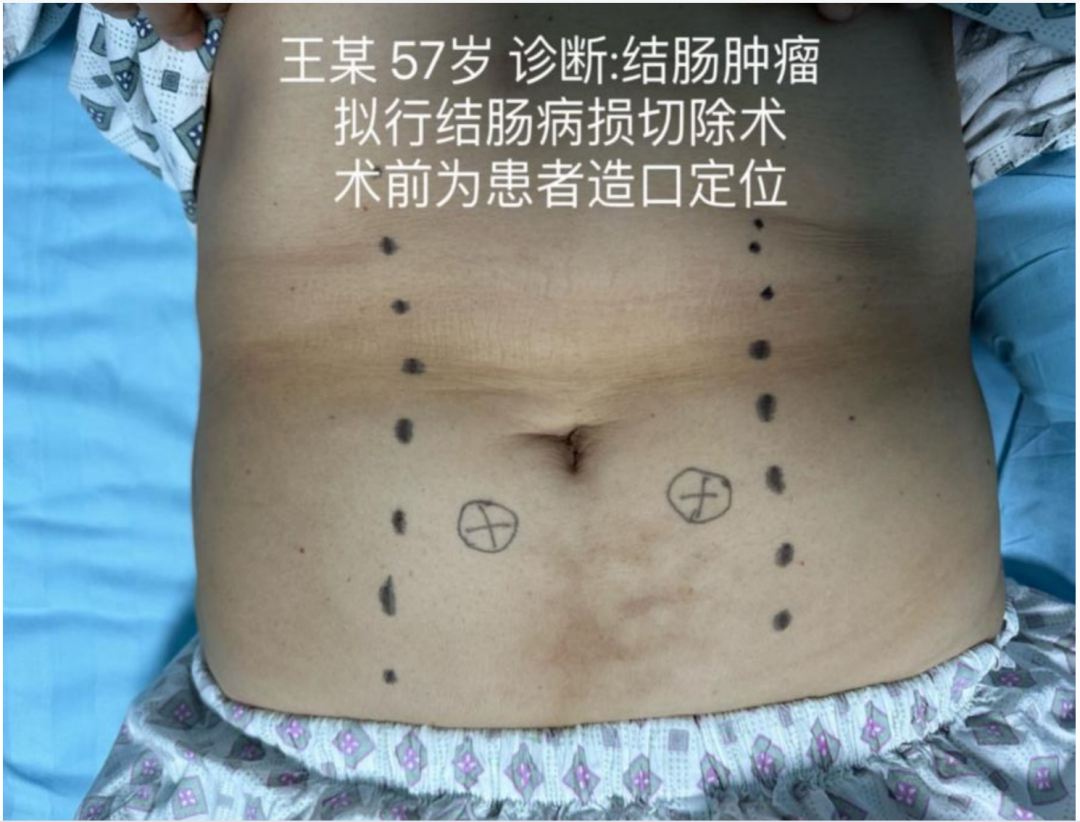 造口有哪些品牌微服务 超满意丨山东省立第三医院护理服务品牌之胃肠外科始于细微，见于平凡_https://www.jmylbn.com_新闻资讯_第3张