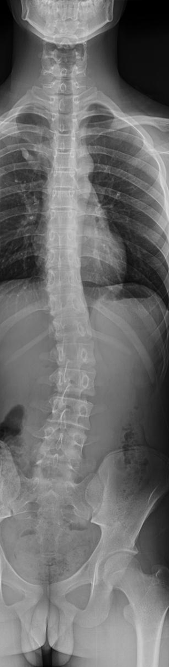 新华 dr 怎么样冠县新华医院丨科普 — 脊柱全长DR摄影，让脊柱侧弯发现的早一点_https://www.jmylbn.com_新闻资讯_第4张