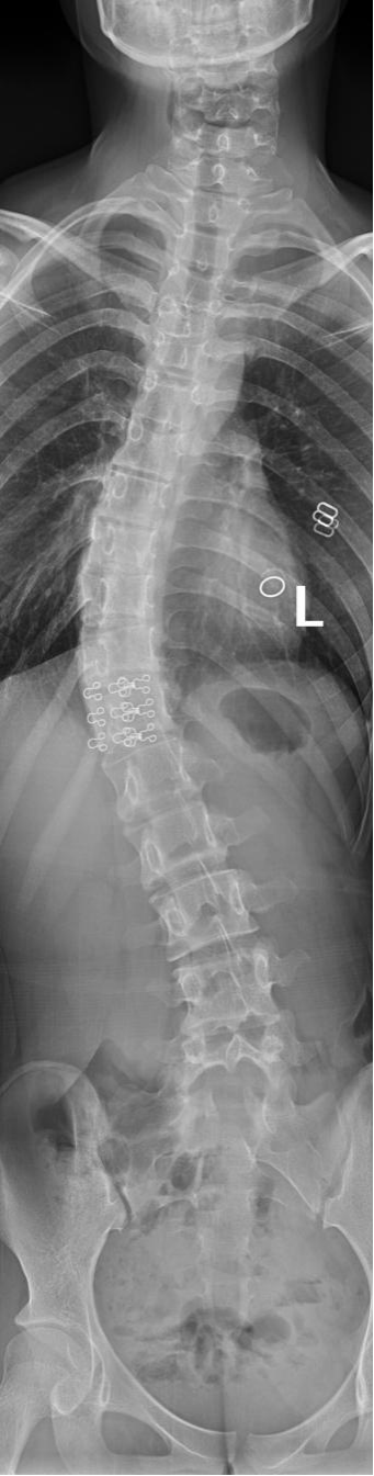 新华 dr 怎么样冠县新华医院丨科普 — 脊柱全长DR摄影，让脊柱侧弯发现的早一点_https://www.jmylbn.com_新闻资讯_第3张