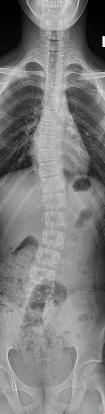 新华 dr 怎么样冠县新华医院丨科普 — 脊柱全长DR摄影，让脊柱侧弯发现的早一点_https://www.jmylbn.com_新闻资讯_第2张