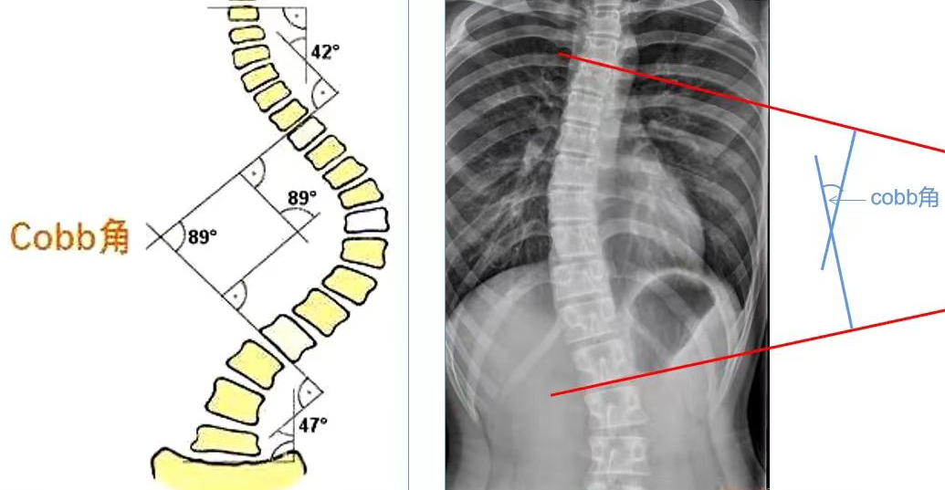 新华 dr 怎么样冠县新华医院丨科普 — 脊柱全长DR摄影，让脊柱侧弯发现的早一点_https://www.jmylbn.com_新闻资讯_第5张