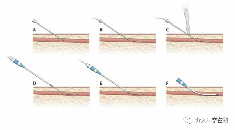 怎么上穿刺鞘介入最重要的基本功，你真的会了吗？图文详解股动脉穿刺，带你涨姿势！_https://www.jmylbn.com_新闻资讯_第4张