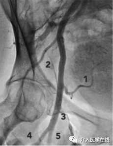 怎么上穿刺鞘介入最重要的基本功，你真的会了吗？图文详解股动脉穿刺，带你涨姿势！_https://www.jmylbn.com_新闻资讯_第1张