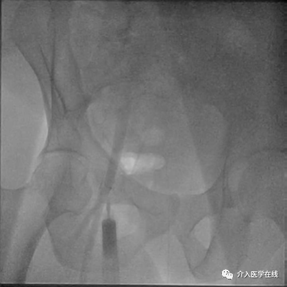 怎么上穿刺鞘介入最重要的基本功，你真的会了吗？图文详解股动脉穿刺，带你涨姿势！_https://www.jmylbn.com_新闻资讯_第9张