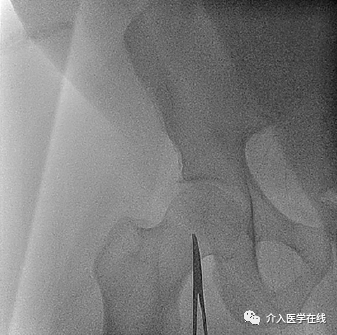 怎么上穿刺鞘介入最重要的基本功，你真的会了吗？图文详解股动脉穿刺，带你涨姿势！_https://www.jmylbn.com_新闻资讯_第7张