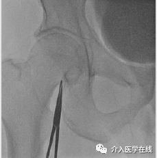 怎么上穿刺鞘介入最重要的基本功，你真的会了吗？图文详解股动脉穿刺，带你涨姿势！_https://www.jmylbn.com_新闻资讯_第2张