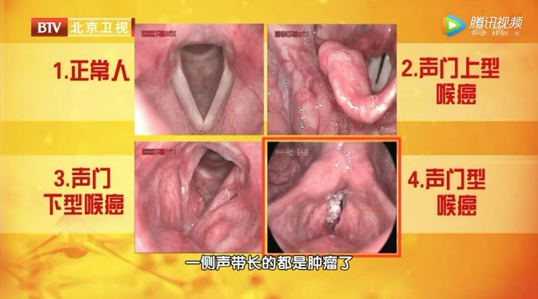 嗓子逐漸變啞竟然和癌症有關 專家説廚房油煙 抽煙 喝酒等都可能會導致這種癌症 北京電視台 微文庫