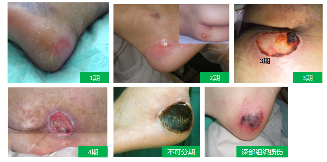 医用泡沫贴怎么用压疮护理不用愁！医用褥疮贴买一送一！_https://www.jmylbn.com_新闻资讯_第2张