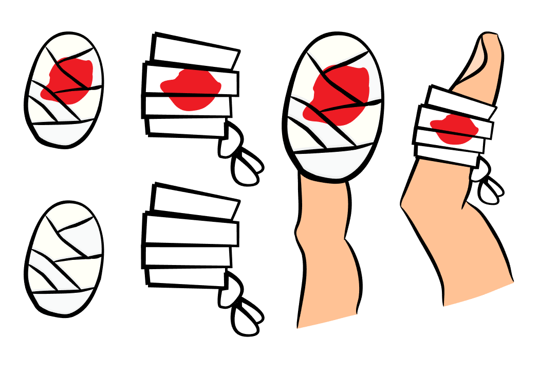 动脉什么压迫止血【健康科普】各部位指压止血方法，建议收藏_https://www.jmylbn.com_新闻资讯_第11张