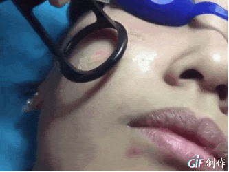 二氧化碳(co2)激光治疗是什么痘坑克星---二氧化碳激光疗法_https://www.jmylbn.com_新闻资讯_第6张