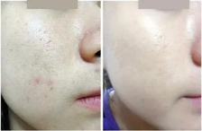 二氧化碳(co2)激光治疗是什么痘坑克星---二氧化碳激光疗法_https://www.jmylbn.com_新闻资讯_第11张