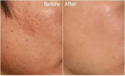 二氧化碳(co2)激光治疗是什么痘坑克星---二氧化碳激光疗法_https://www.jmylbn.com_新闻资讯_第10张