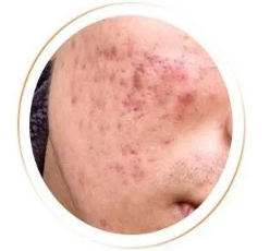 二氧化碳(co2)激光治疗是什么痘坑克星---二氧化碳激光疗法_https://www.jmylbn.com_新闻资讯_第3张