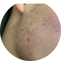 二氧化碳(co2)激光治疗是什么痘坑克星---二氧化碳激光疗法_https://www.jmylbn.com_新闻资讯_第2张