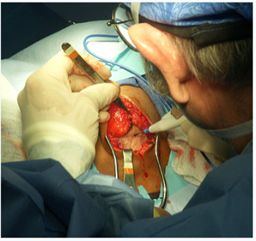 为什么手术用电刀2例手术电外科烧伤，生疼！哪个环节出了错？_https://www.jmylbn.com_新闻资讯_第5张